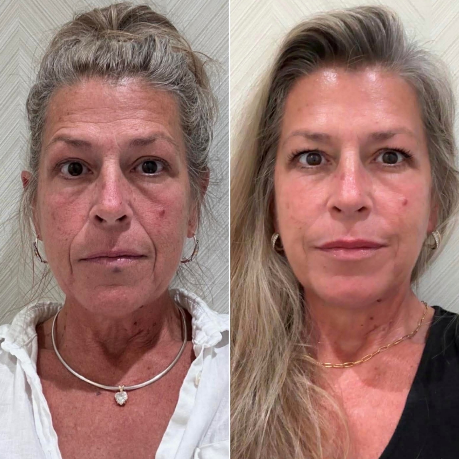 Real Eternal MedSpa client result with conservative cheek lip and chin filler wrinkle relaxers and medical-grade skincare