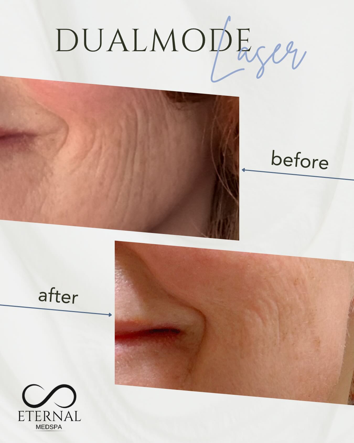Real Eternal MedSpa client before and after DualMode laser result after one session and one week of healing